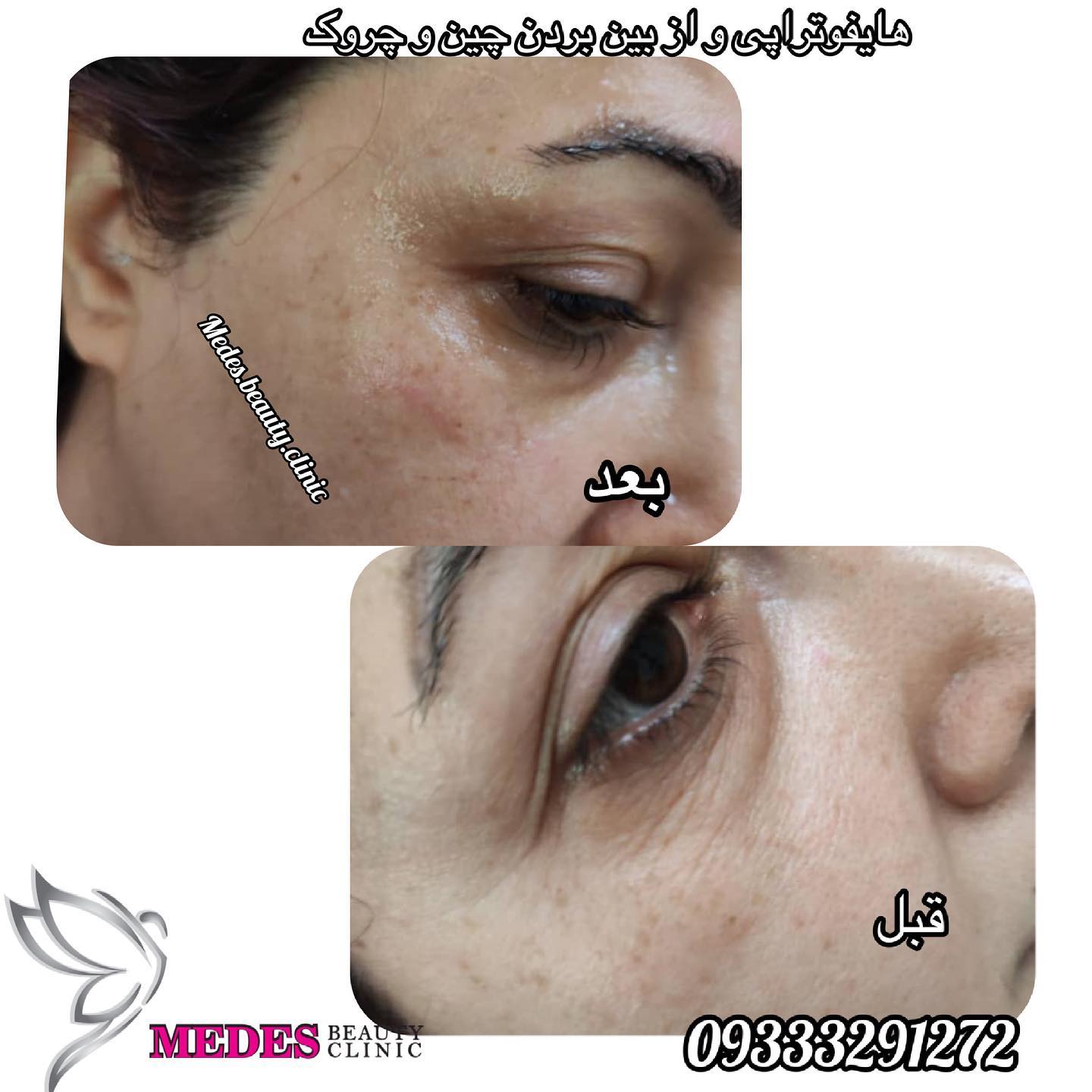 گالری هایفوتراپی